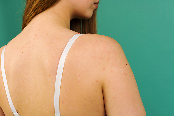 포토 JPG 해외이미지 곤충 신체 건조 한명 사람 동양인 치료 뷰티 약 손상 뜨거움 거친 질병 피부 크림 문제 팔 토막 알레르기 두드러기 명패 모기 염증 팔꿈치 해외포토 동물 1 컨셉 의학 인종 신체부위 해충 파일형식 이미지허브