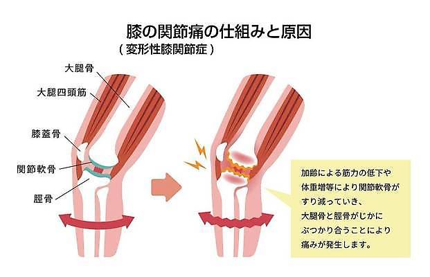 EPS 해외이미지 여자 과학 신체 일러스트 해부 뼈 골격 건강 사람 그래픽 치료 약 고통 환자 흰색 오르간 질병 심볼 관절염 생물학 무릎 테라피 돌봄 썩음 옛날 정형외과 해외일러스트 교육 감정 컬러 의학 모션 병원 신체부위 뷰티 건반악기 파일형식 벡터 이미지허브