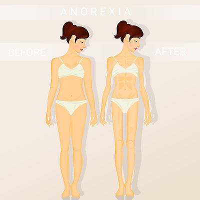 포토 JPG 해외이미지 음식 신체 다이어트 뼈 건강 사람없음 약 죽음 질병 무서움 피부 문제 식욕 얇은 우울증 해외포토 감정 의학 신체부위 파일형식 이미지허브