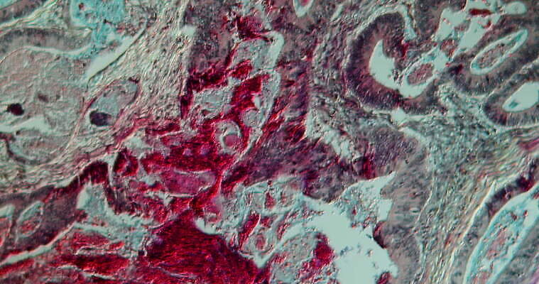 과학 이동 패턴 세포 사람없음 빨간색 파란색 약 시험 성장 조직 확대 질병 종양 지원 4K 현미경관찰 MOV 해외동영상 클립영상 교육 컬러 컨셉 무늬 의학 관찰 동영상 파일형식