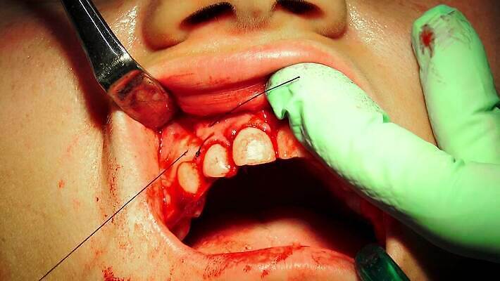 직업 손 왕관 뼈 건강 치과 병원 사람 소년 치료 약 금속 방 장비 과학기술 환자 의사 흰색 오픈 입 수술 치아 자르기 입술 부식 치과의사 뿌리 외과 턱 돌봄 바늘땀 보철 썩음 위생관리 잇몸 살균 4K MP4 해외동영상 클립영상 남자 어린이 컬러 신체 의학 모션 재질 기술 관리 신체부위 의료진 소화기관 동영상 파일형식