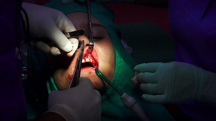 직업 손 왕관 뼈 건강 치과 병원 사람 소년 치료 약 금속 방 장비 과학기술 환자 의사 흰색 오픈 입 수술 치아 자르기 입술 부식 치과의사 뿌리 외과 턱 돌봄 바늘땀 보철 썩음 위생관리 잇몸 살균 4K MP4 해외동영상 클립영상 남자 어린이 컬러 신체 의학 모션 재질 기술 관리 신체부위 의료진 소화기관 동영상 파일형식