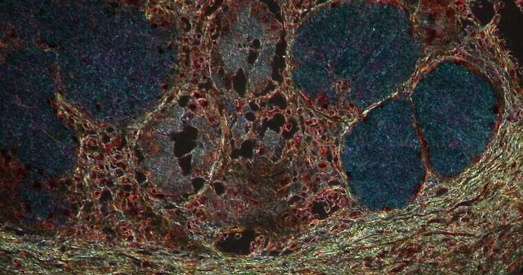 과학 이동 패턴 세포 사람없음 빨간색 파란색 약 시험 성장 조직 확대 지원 천식 4K 현미경관찰 MOV 해외동영상 클립영상 교육 컬러 컨셉 무늬 의학 관찰 질병 동영상 파일형식