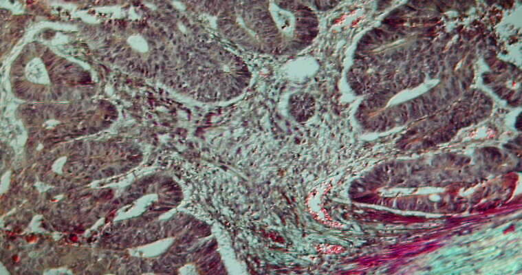 과학 이동 패턴 세포 사람없음 빨간색 파란색 약 시험 성장 조직 확대 질병 종양 지원 4K 현미경관찰 MOV 해외동영상 클립영상 교육 컬러 컨셉 무늬 의학 관찰 동영상 파일형식