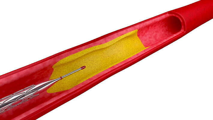 건강 사람없음 3D 하트 심장 혈액 질병 공격 자르기 뇌 철사 풍선 튜브 외과 정맥 순서 명패 심장병 타격 MOV 해외동영상 클립영상 모양 의학 모션 병원 장기_의학 디지털합성 혈관 동영상 파일형식