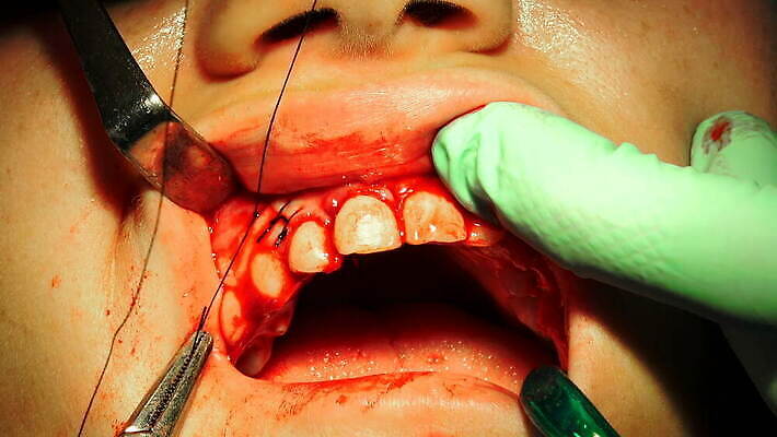 직업 손 여자 부분 건강 치과 병원 사람 치료 약 방 환자 의사 도구 긴급 입 구멍 수술 닫기 치아 상처 플라스틱 사건 치과의사 뿌리 운하 외과 돌봄 바늘땀 잇몸 작동 살균 실종 4K MOV 해외동영상 클립영상 신체 의학 모션 재질 신체부위 의료진 소화기관 동영상 파일형식