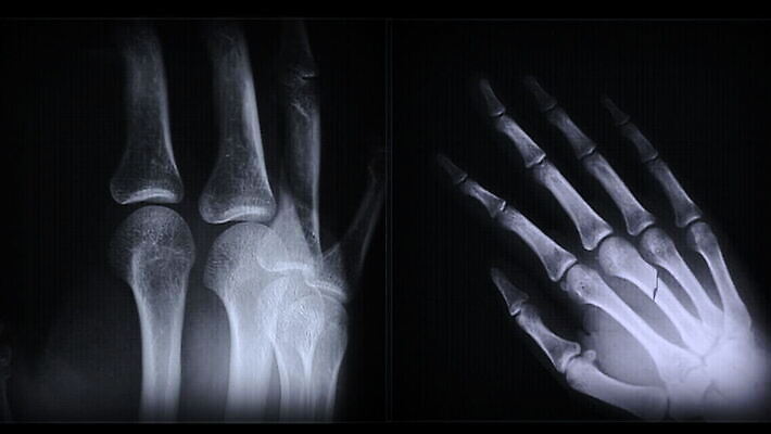 손 백그라운드 뼈 엑스레이 병원 사람없음 약 의료계 MOV 해외동영상 클립영상 의학 신체부위 동영상 파일형식