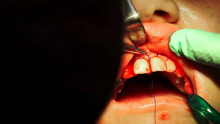 직업 손 장갑 건강 병원 사람 치료 약 고통 장비 환자 간호사 의사 공구 긴급 바늘 입 혈액 수술 실 치아 질병 상처 자르기 사건 피부 치과의사 땀 외과 순서 돌봄 보유 절개 치유 흉터 살균 4K MOV 해외동영상 클립영상 잡화 감정 의학 모션 신체부위 의료진 도구 소화기관 동영상 파일형식