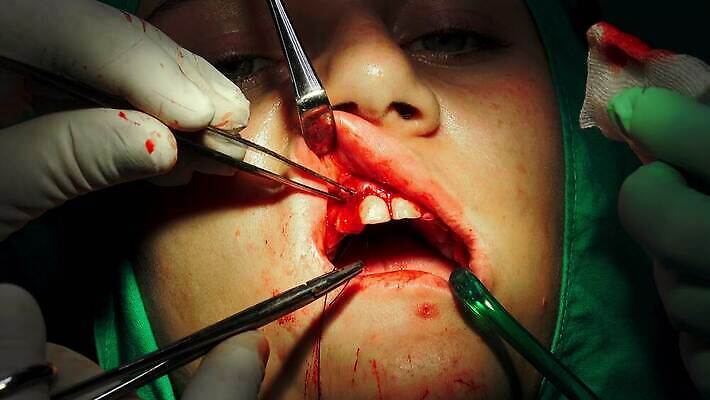 직업 손 왕관 뼈 건강 치과 병원 사람 소년 치료 약 금속 방 장비 과학기술 환자 의사 흰색 오픈 입 수술 치아 자르기 입술 부식 치과의사 뿌리 외과 턱 돌봄 바늘땀 보철 썩음 위생관리 잇몸 살균 4K MP4 해외동영상 클립영상 남자 어린이 컬러 신체 의학 모션 재질 기술 관리 신체부위 의료진 소화기관 동영상 파일형식