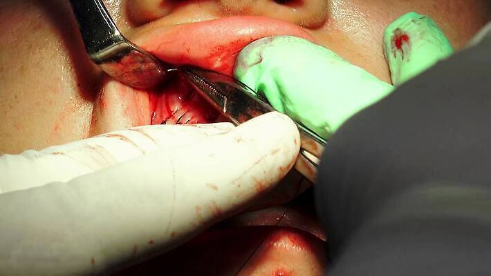 직업 손 장갑 건강 병원 사람 치료 약 고통 장비 환자 간호사 의사 공구 긴급 바늘 입 혈액 수술 실 치아 질병 상처 자르기 사건 피부 치과의사 땀 외과 순서 돌봄 보유 절개 치유 흉터 살균 4K MP4 해외동영상 클립영상 잡화 감정 의학 모션 신체부위 의료진 도구 소화기관 동영상 파일형식