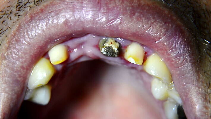 백그라운드 왕관 건강 치과 미소 사람 약 환자 흰색 도자기 입 치아 치과의사 틀니 깨짐 돌봄 보철 인공 못생김 MOV 해외동영상 클립영상 컬러 컨셉 의학 모션 표정 병원 신체부위 의사 소화기관 동영상 파일형식