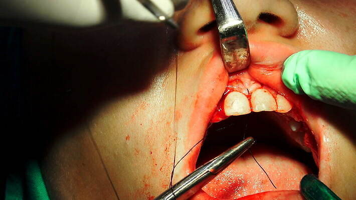 직업 손 여자 부분 건강 치과 병원 사람 치료 약 방 환자 의사 도구 긴급 입 구멍 수술 닫기 치아 상처 플라스틱 사건 치과의사 뿌리 운하 외과 돌봄 바늘땀 잇몸 작동 살균 실종 4K MOV 해외동영상 클립영상 신체 의학 모션 재질 신체부위 의료진 소화기관 동영상 파일형식