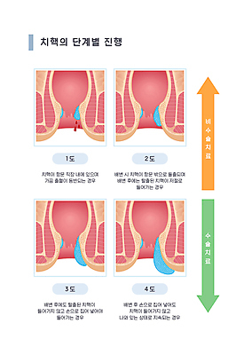 화살표 일러스트 의학 사람없음 질병 단계 구분 출혈 치질 항문 내치핵 국내일러스트 AI파일 소화기관 혈액 파일형식 벡터