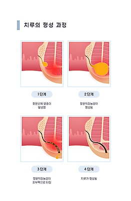 일러스트 의학 사람없음 질병 과정 단계 순서 염증 치질 항문 농양 치루 국내일러스트 AI파일 컨셉 소화기관 파일형식 벡터