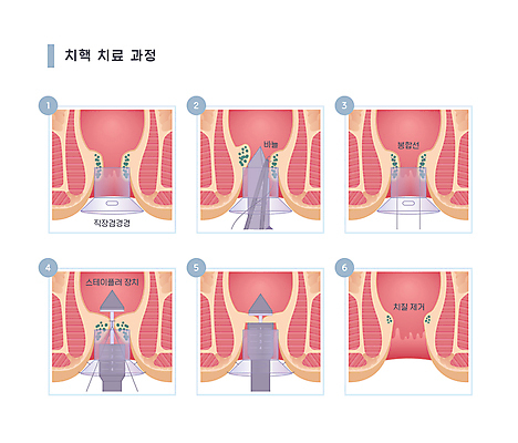 일러스트 의학 의료기기 사람없음 치료 질병 과정 단계 순서 치질 항문 국내일러스트 AI파일 컨셉 소화기관 파일형식 벡터