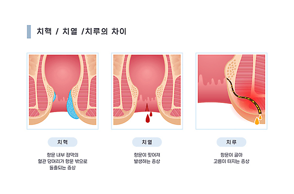 일러스트 의학 사람없음 비교 질병 분석 염증 출혈 치질 항문 농양 치루 치열 국내일러스트 AI파일 컨셉 소화기관 혈액 파일형식 벡터
