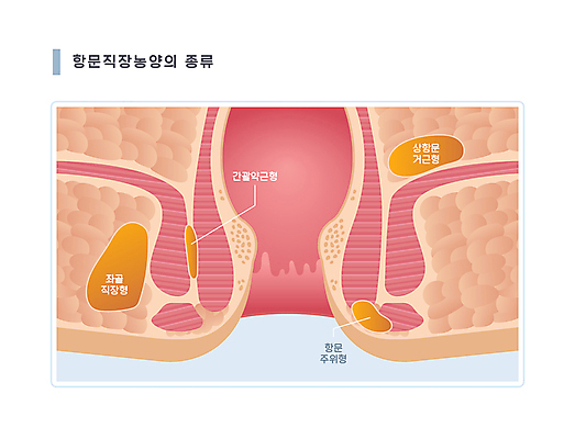 일러스트 의학 종류 사람없음 질병 분석 염증 치질 항문 농양 국내일러스트 AI파일 컨셉 소화기관 파일형식 벡터