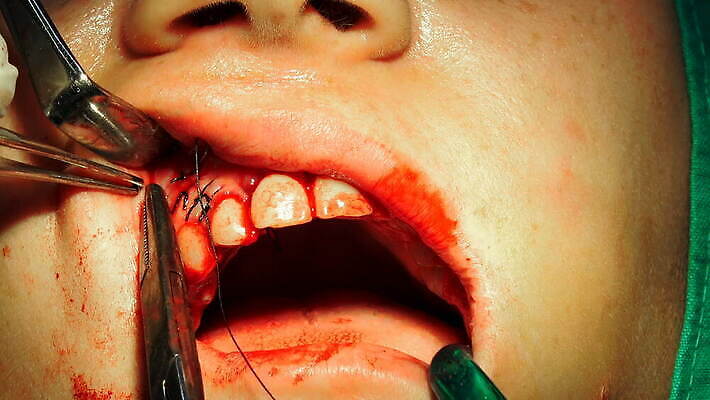 표면 건강 손잡이 약 반사 금속 잠김 의사 도구 입 수술 닫기 치아 오브젝트 치과의사 외과 순서 돌봄 바늘땀 보유 철강 살균 4K MOV 해외동영상 클립영상 의학 모션 재질 병원 신체부위 치료 의료진 소화기관 동영상 파일형식