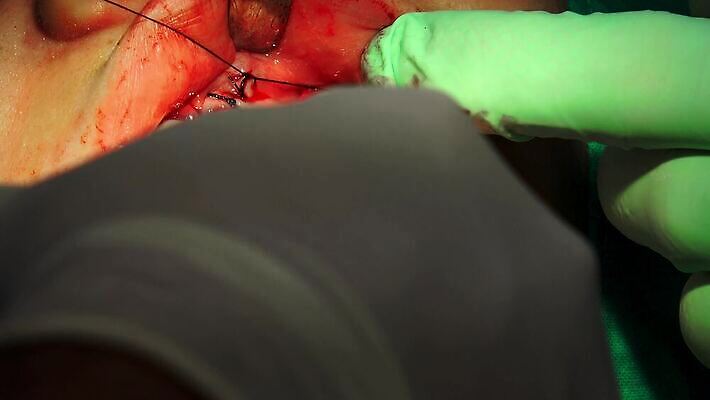 손 뼈 건강 치과 치료 약 고통 환자 공구 오픈 입 구멍 혈액 수술 치아 상처 바느질 부식 치과의사 땀 뿌리 주인 틀니 순서 돌봄 바늘땀 위생관리 치아교정 치통 4K 구강학 MP4 해외동영상 클립영상 감정 의학 모션 병원 관리 신체부위 의사 도구 소화기관 질병 교정 동영상 파일형식