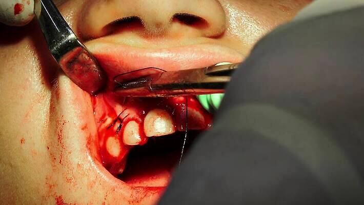 손 뼈 건강 치과 치료 약 고통 환자 공구 오픈 입 구멍 혈액 수술 치아 상처 바느질 부식 치과의사 땀 뿌리 주인 틀니 순서 돌봄 바늘땀 위생관리 치아교정 치통 4K 구강학 MP4 해외동영상 클립영상 감정 의학 모션 병원 관리 신체부위 의사 도구 소화기관 질병 교정 동영상 파일형식