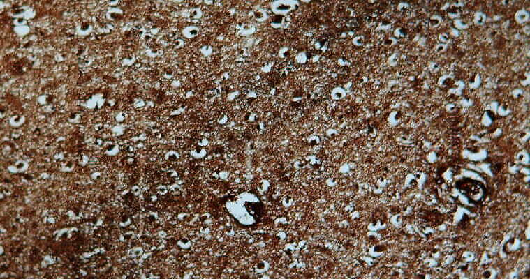 생각 해부 세포 건강 병원 사람없음 파란색 약 갈색 진료 고통 의사 기구 조직 확대 질병 고장 뇌 섬유 돌봄 명패 치매 4K MOV 해외동영상 클립영상 감정 컬러 의학 모션 의료진 직물 동영상 파일형식