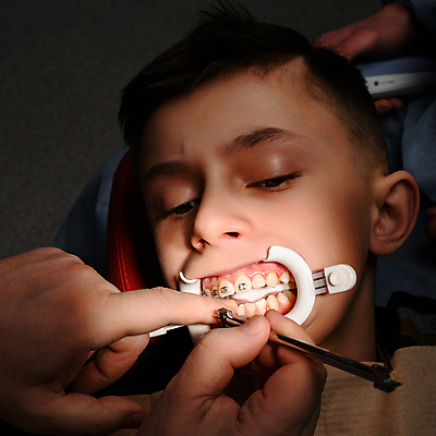 포토 JPG 해외이미지 직업 라이프스타일 건강 치과 병원 한명 치료 10대 약 건강관리 환자 의사 공구 작업 입 고리 닫기 치아 치과의사 고정 고무 테라피 틀니 순서 게이지 돌봄 철강 치아교정 구강학 해외202309 해외포토 1 의학 모션 청소년 관리 사람 생활 신체부위 뷰티 의료진 도구 소화기관 교정 파일형식