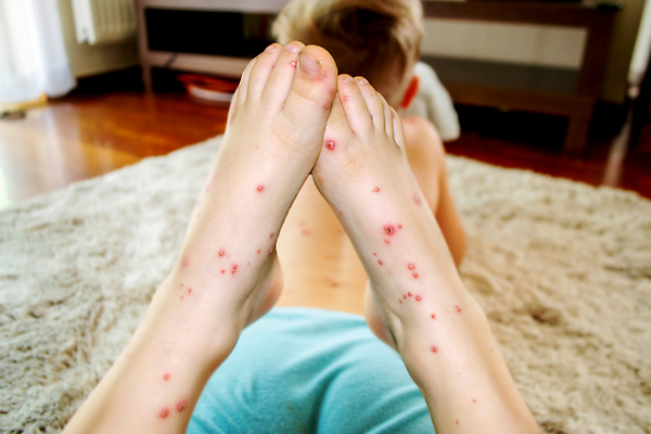 포토 JPG 해외이미지 남자 어린이 건강 두명 신체부위 빨간색 약 고통 환자 점 열 바이러스 질병 작음 피부 낫 걸음마 돌봄 증상 해외202309 해외포토 감정 컬러 의학 모션 사람 크기 파일형식