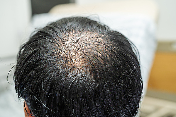 포토 JPG 해외이미지 신체부위 머리카락 머리 걱정 헤어관리 두피 탈모 해외202309 해외포토 감정 사람 뷰티 증상 파일형식