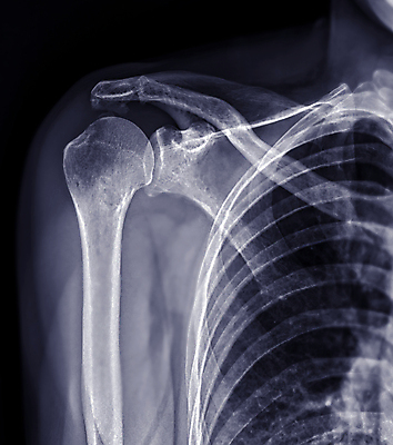 포토 JPG 해외이미지 해부 근육 뼈 스트레스 골격 건강 병원 사람없음 고통 시험 환자 광선 투명 오르간 질병 상처 X 사건 필름 관절염 문제 팔 골절 단절 방사선 정형외과 증상 해외202309 해외포토 알파벳 교육 감정 의학 신체부위 건반악기 파일형식