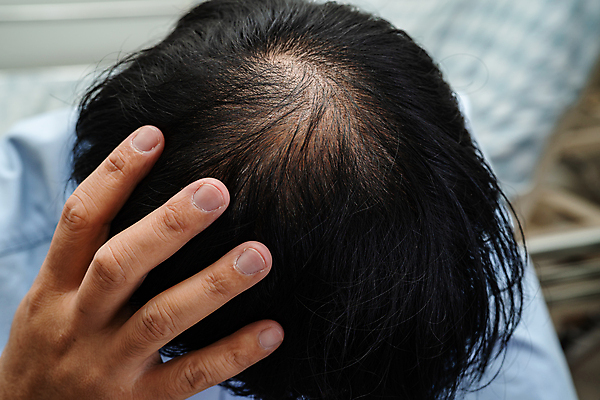 포토 JPG 해외이미지 손 신체부위 머리카락 머리 걱정 헤어관리 두피 탈모 해외202309 해외포토 감정 사람 뷰티 증상 파일형식