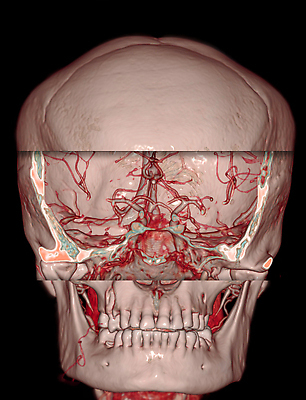 포토 JPG 해외이미지 과학 해부 의료기기 건강 병원 사람 사람없음 약 머리 시험 환자 질병 뇌 두통 동맥 방사선 타격 해골모형 해외202309 해외포토 교육 의학 모션 신체부위 모형 혈관 파일형식