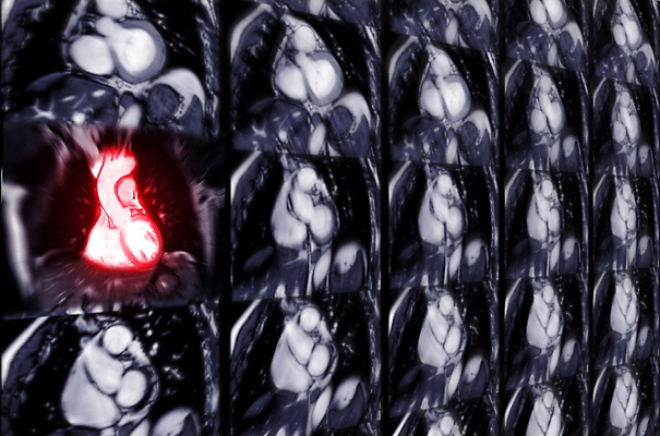 포토 JPG 해외이미지 엑스레이 건강 사람없음 그래픽 환자 심장 맥박 질병 공격 회의실 순환 함선 동맥 궤 돌봄 방사선 심장병 타격 해외202309 해외포토 배_교통 의학 모션 장기_의학 혈관 파일형식