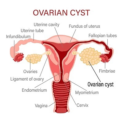 EPS 해외이미지 일러스트 사람없음 질병 자궁 난소 여성질환 종양 증상 해외202309 해외일러스트 의학 장기_의학 파일형식 벡터
