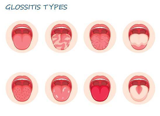 EPS 해외이미지 일러스트 해부 건강 사람 치료 약 고통 환자 흰색 입 오르간 바이러스 치아 질병 혀 입술 감염 문제 박테리아 고립 곰팡이 염증 이스트 증상 해로움 벡터 구내염 해외202309 해외일러스트 감정 컬러 컨셉 의학 신체부위 소화기관 건반악기 파일형식