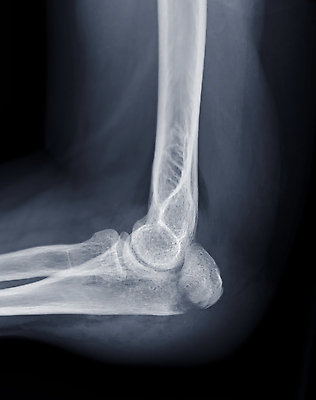 포토 JPG 해외이미지 손 백그라운드 신체 부분 해부 벽지 뼈 골격 병원 사람 사람없음 약 고통 장비 시험 환자 흰색 긴급 질병 사건 필름 라디오 팔 골절 단절 부담 염증 정형외과 팔꿈치 해외202309 해외포토 교육 감정 컬러 의학 신체부위 전자제품 파일형식