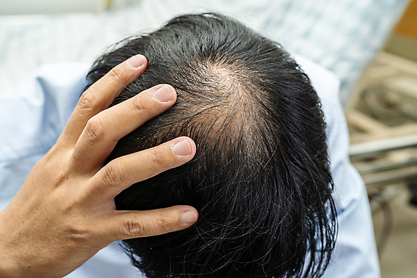 포토 JPG 해외이미지 손 신체부위 머리카락 머리 걱정 헤어관리 두피 탈모 해외202309 해외포토 감정 사람 뷰티 증상 파일형식