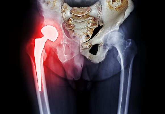 포토 JPG 해외이미지 신체 해부 뼈 골격 건강 병원 사람 사람없음 검은색 고통 환자 의사 광선 기둥 질병 엉덩이 필름 허리 척추 사인 골다공증 방광 돌봄 정형외과 해외202309 해외포토 건축 감정 컬러 의학 모션 신체부위 의료진 비뇨기관 파일형식
