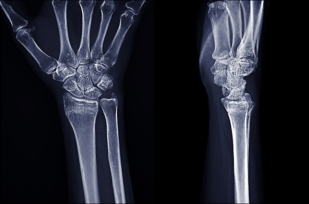 포토 JPG 해외이미지 손 손가락 뼈 골격 건강 병원 손바닥 사람 사람없음 약 고통 시험 환자 엄지손가락 광선 반지 질병 X 사건 손목 관절염 관절 인덱스 고립 골절 돌봄 부정적 정형외과 해외202309 해외포토 알파벳 교육 감정 장신구 의학 모션 신체부위 파일형식