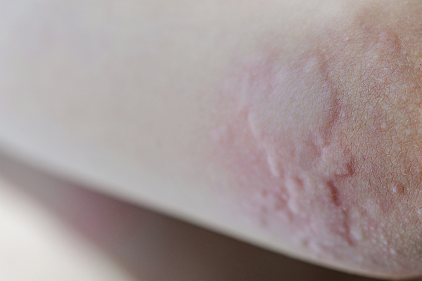 포토 JPG 해외이미지 백인 어린이 백그라운드 신체 사람없음 빨간색 약 고통 환자 닫기 질병 피부 질감 감염 문제 알레르기 돌봄 반응 심각 증상 해외202309 해외포토 서양인 감정 컬러 컨셉 의학 모션 사람 신체부위 파일형식