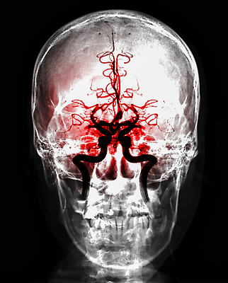 포토 JPG 해외이미지 해부 엑스레이 건강 병원 사람 사람없음 치료 약 머리 고통 환자 질병 뇌 함선 두통 동맥 방사선 종양 타격 해외202309 해외포토 감정 배_교통 의학 모션 신체부위 혈관 파일형식