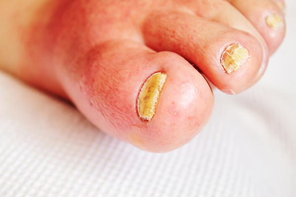 포토 JPG 해외이미지 표면 건강 성인 사람없음 치료 빨간색 약 진료 고통 환자 짜증 열 질병 상처 피부 질감 감염 지역 발목 박테리아 양발 증상 해로움 해외202309 해외포토 감정 컬러 컨셉 의학 발 사람 신체부위 파일형식