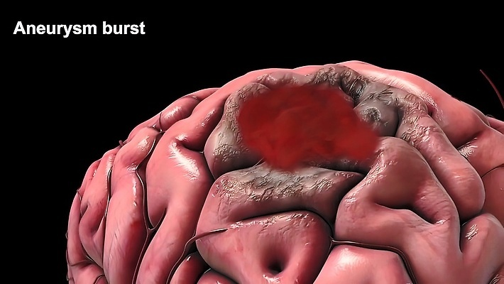 포토 JPG 해외이미지 사람없음 3D 손상 질병 뇌 생물학 신경기관 뇌졸중 뇌출혈 생명과학 해외202309 해외포토 교육 과학 컨셉 의학 장기_의학 디지털합성 파일형식