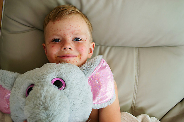 포토 JPG 해외이미지 남자 어린이 건강 소녀 두명 신체부위 빨간색 약 고통 환자 점 열 바이러스 질병 작음 피부 낫 걸음마 돌봄 증상 해외202309 해외포토 여자 감정 컬러 의학 모션 사람 크기 파일형식