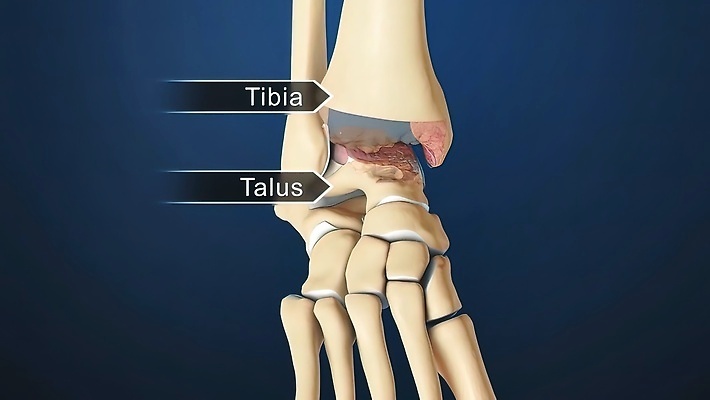 포토 JPG 해외이미지 해부 발 뼈 건강 사람 사람없음 앞모습 치료 약 3D 손상 나사 오르간 수리 자르기 퓨전 관절염 외과 발목 양발 연골 정형외과 해외202309 해외포토 뷰포인트 컨셉 의학 모션 병원 신체부위 공구 건반악기 질병 디지털합성 파일형식