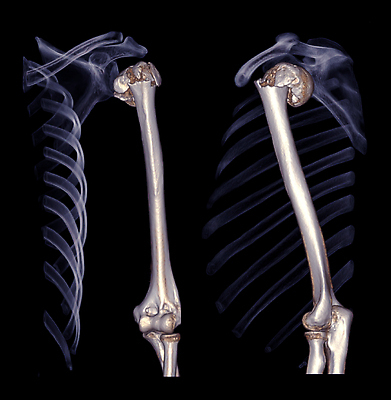 포토 JPG 해외이미지 부분 해부 뼈 골격 병원 사람 사람없음 고통 시험 환자 의사 충돌 사건 어깨 팔 장애 골절 단절 방사선 스캐너 심각 정형외과 팔꿈치 해외202309 해외포토 교육 감정 컨셉 의학 신체부위 의료진 파일형식
