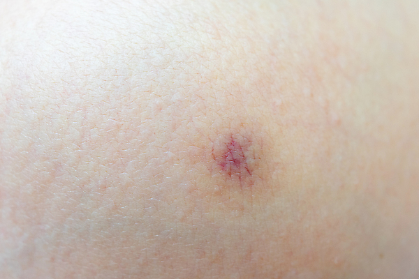 포토 JPG 해외이미지 백인 여자 남자 신체 건강 사람 성인 사람없음 뷰티 약 고통 점 질병 상처 작음 피부 질감 돌봄 효과 해외202309 해외포토 서양인 감정 의학 모션 신체부위 크기 파일형식