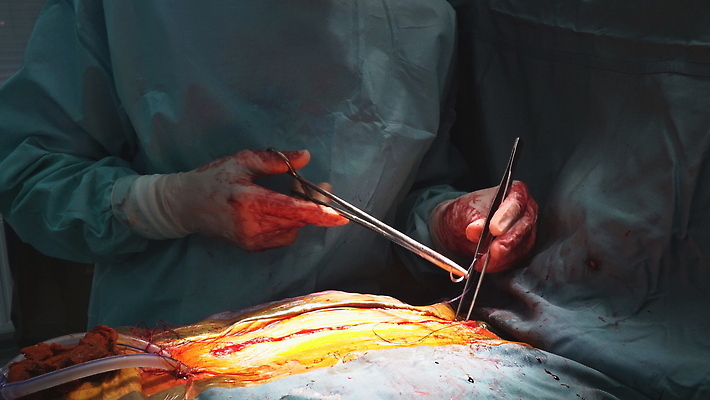 포토 JPG 해외이미지 과학 건강 병원 한명 약 장비 환자 의사 심장 수술 외과 교체 궤 보철 심장병 인공 절개 해외202309 해외포토 1 의학 사람 치료 의료진 장기_의학 질병 파일형식