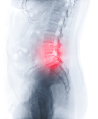 포토 JPG 해외이미지 모델 과학 백그라운드 곡선 신체 뼈 골격 엑스레이 병원 숙이기 사람 사람없음 약 검은색 고통 환자 의사 광선 기둥 디스크 비교 질병 필름 허리 척추 골다공증 돌봄 방사선 요통 정형외과 해외202309 해외포토 건축 감정 선 컬러 포즈 컨셉 의학 모션 신체부위 의료진 허리통증 파일형식