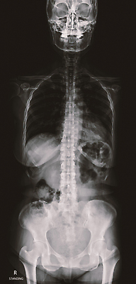 포토 JPG 해외이미지 과학 백그라운드 곡선 신체 해부 뼈 골격 엑스레이 건강 병원 숙이기 서기 사람 사람없음 약 검은색 고통 환자 의사 광선 흰색 기둥 디스크 비교 질병 필름 허리 척추 골다공증 돌봄 방사선 정형외과 해외202309 해외포토 건축 감정 선 컬러 포즈 컨셉 의학 모션 신체부위 의료진 파일형식