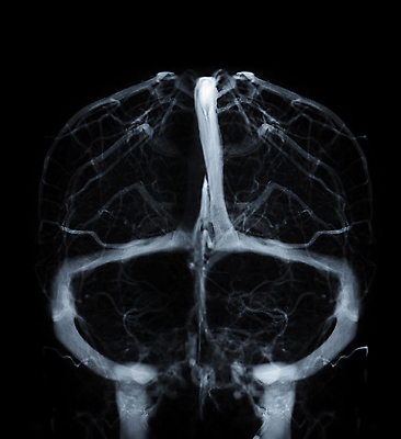 포토 JPG 해외이미지 건강 병원 사람없음 치료 약 머리 고통 흐름 환자 질병 속도 뇌 함선 두통 평가 종양 타격 해골모형 해외202309 해외포토 감정 컨셉 배_교통 의학 모션 신체부위 모형 파일형식